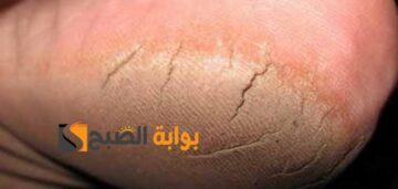 طرق فعالة لحل مشكلة تشقق القدمين تبييض وتفتيح ومش هتندمي
