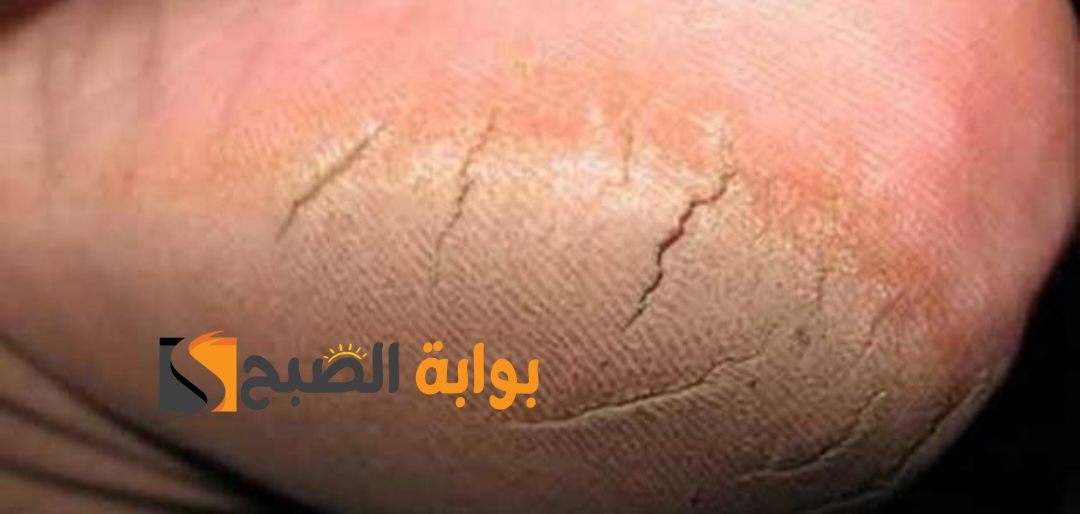 طرق فعالة لحل مشكلة تشقق القدمين تبييض وتفتيح ومش هتندمي 5 طرق فعالة لحل مشكلة تشقق القدمين تبييض وتفتيح ومش هتندمي