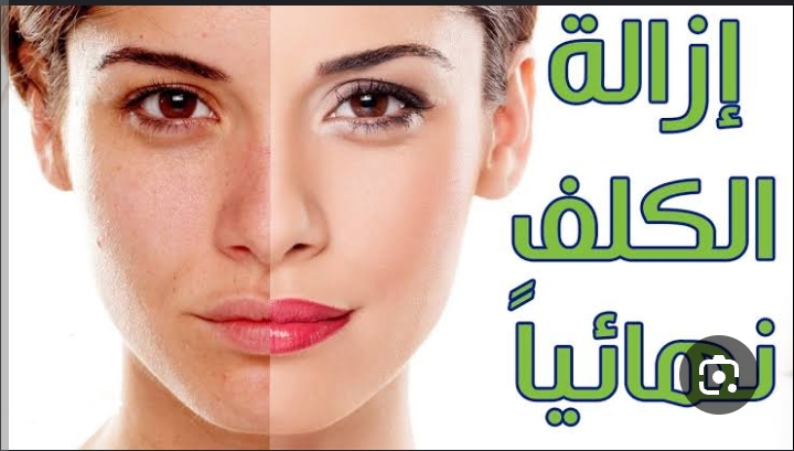 اقوى الوصفات الطبيعية المجربة للتخلص من الكلف والنمش تدريجياً 5 اقوى الوصفات الطبيعية المجربة للتخلص من الكلف والنمش تدريجياً