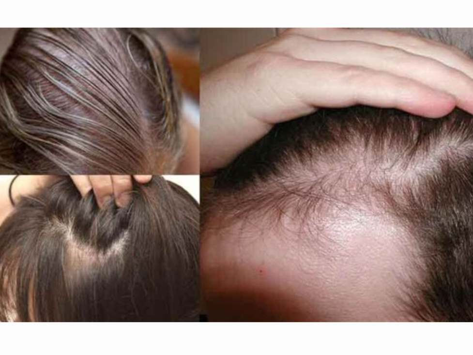 وداعا لتساقط الشعر مع وصفة زيت الزيتون والثوم 5 وداعا لتساقط الشعر مع وصفة زيت الزيتون والثوم