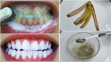 هترجع ناصعة البياض.. طريقة تبيض الاسنان باستخدام قشر الموز وهتنبسطي من النتيجة