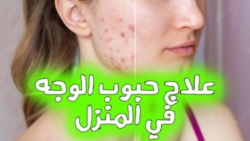 “هتختفي تماما” وصفة لإزالة الحبوب من الوجه للبشرة الدهنية بشكل طبيعي!!