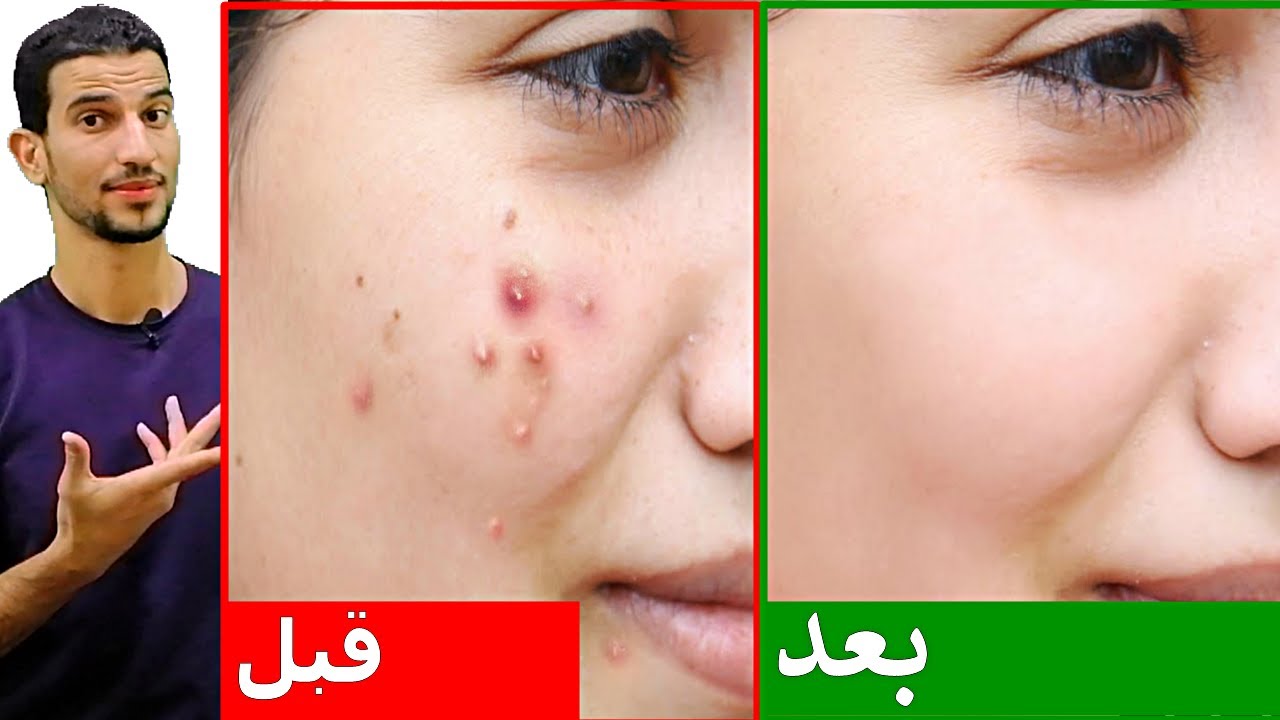 أفضل وصفات طبيعية لعلاج الحبوب من البشرة هتختفي من أول يوم