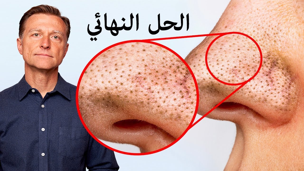 أسرع طريقة لعلاج الرؤوس السوداء والتجاعيد بشكل فعال من أول مرة