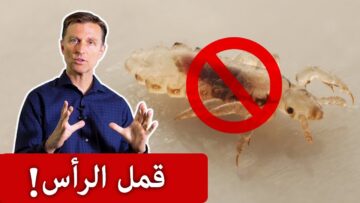 أقوى وصفة للتخلص من حشرات الشعر وأيضًا قشرة الشعر وداعًا للمعاناة