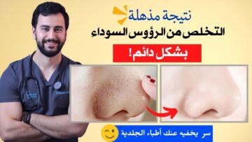 تخلصي في الحال من الرؤوس السوداء من الأنف بأقل التكاليف وأسهل الخطوات