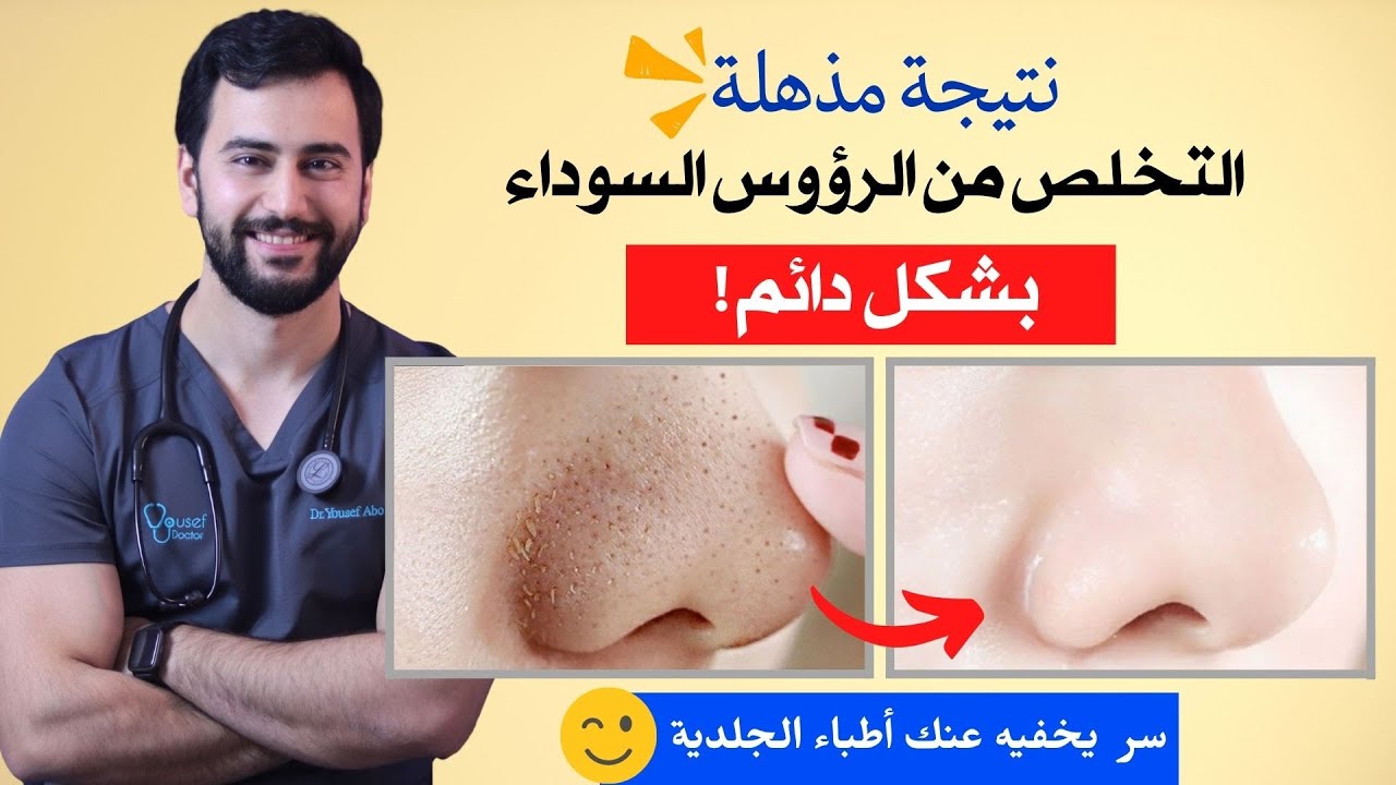 تخلصي في الحال من الرؤوس السوداء من الأنف بأقل التكاليف وأسهل الخطوات 5 تخلصي في الحال من الرؤوس السوداء من الأنف بأقل التكاليف وأسهل الخطوات
