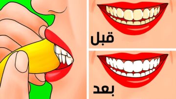 نتيجة مبهرة.. طريقة تبييض الأسنان باستخدام قشر الموز