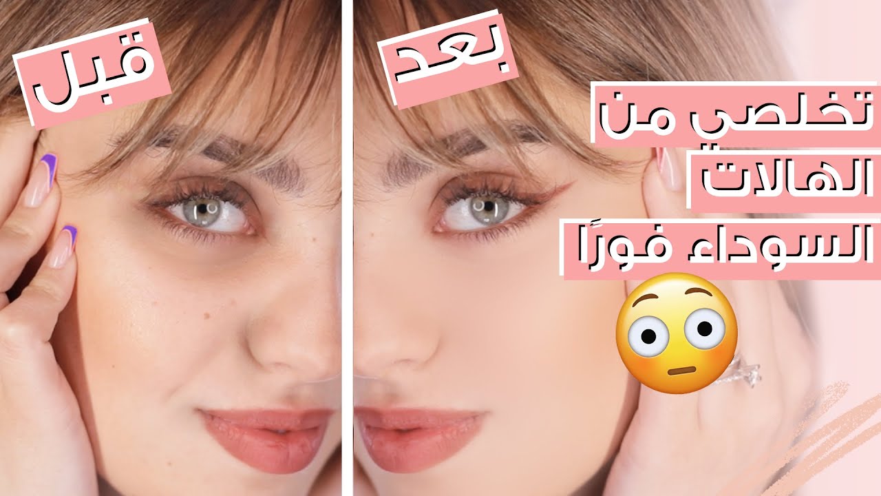 تخلصي من الهالات السوداء في أسبوع واحد باستخدام خلطات طبيعية 100% 5 تخلصي من الهالات السوداء في أسبوع واحد باستخدام خلطات طبيعية 100%