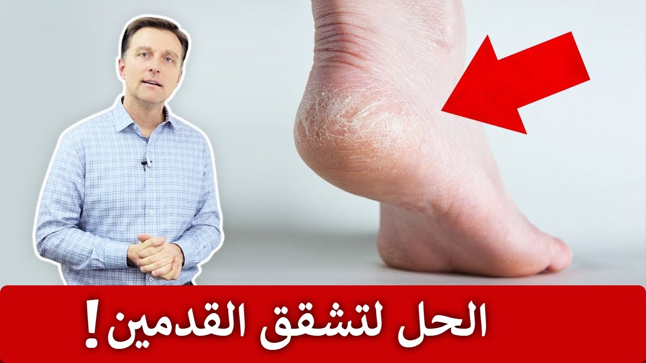 علاج تشقق القدمين بمكونات متوفرة في البيت ونتيجة سريعة ومضمونة 5 علاج تشقق القدمين بمكونات متوفرة في البيت ونتيجة سريعة ومضمونة