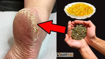 وصفات طبيعية لعلاج تشقق الكعبين لامتلاك قدمين ناعمتين في الشتاء
