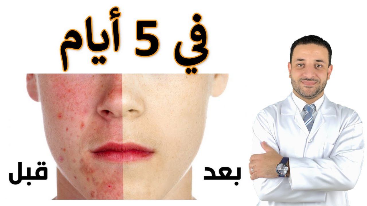 مكون رائع لحب الشباب في منزلك هيقضي على الحبوب وآثارها نهائيًا من أول مرة