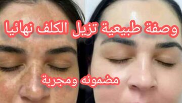 وصفات طبيعية لإزالة البقع الداكنة والتخلص منها!!!