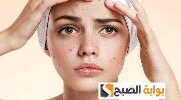 وصفة لإزالة حب الشباب بسرعة في البيت تفتيح ونضارة لبشرة صافية