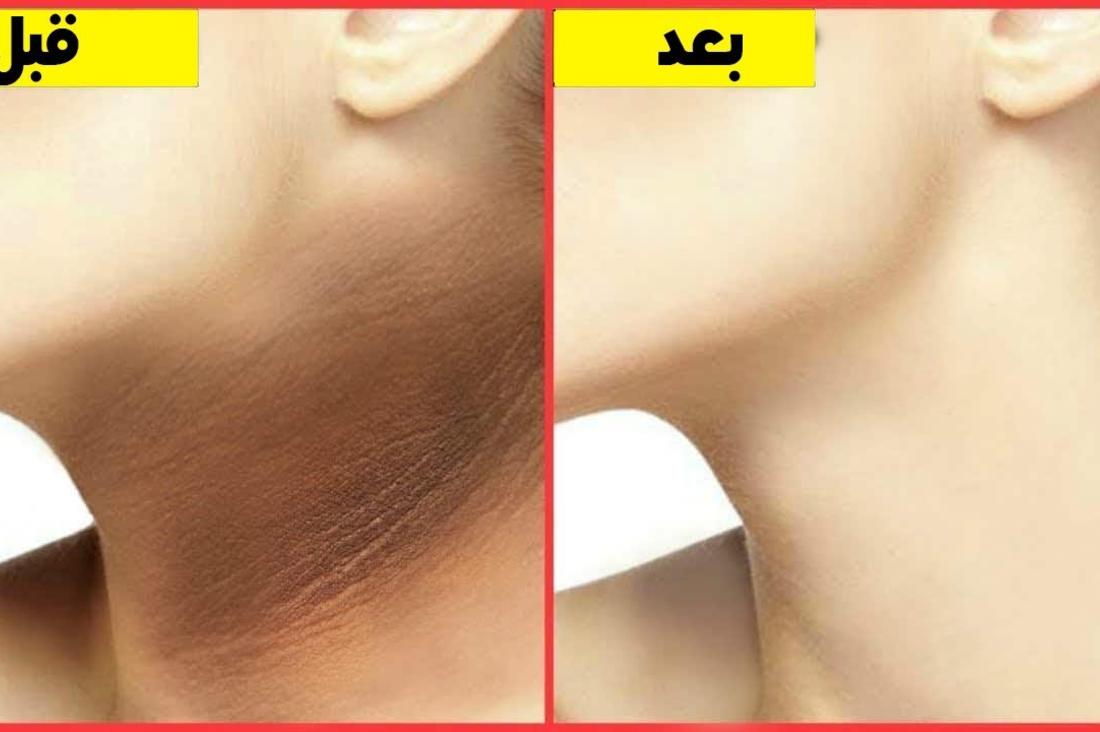 هتبقى زي القشطة.. اقوى وصفة لتبيض الرقبة وإزالة بقع وتصبغات وإزالة التجاعيد وجعلها بيضاء 5 هتبقى زي القشطة.. اقوى وصفة لتبيض الرقبة وإزالة بقع وتصبغات وإزالة التجاعيد وجعلها بيضاء