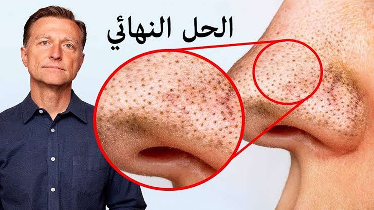 بمكونات صحية ومن منزلك تخلصي من الرؤوس السوداء نهائياً بوصفة طبيعية خالية من أي أضرار 5 بمكونات صحية ومن منزلك تخلصي من الرؤوس السوداء نهائياً بوصفة طبيعية خالية من أي أضرار