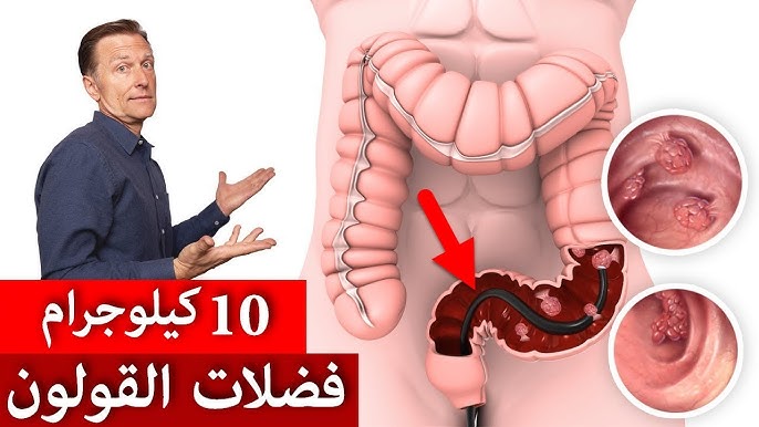 مش هتروح لدكتور تانى.. تنظيف القولون من التراكمات وسموم الجسم بدون ادويه وبطريقة طبيعية 5 مش هتروح لدكتور تانى.. تنظيف القولون من التراكمات وسموم الجسم بدون ادويه وبطريقة طبيعية