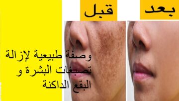 أقوي وصفة طبيعية للقضاء على التصبغات والبقع الداكنة بشكل سريع