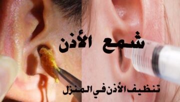 مش هتحس بألم نهائي.. طريقة تنظيف الأذن من الشمع في المنزل بكل سهولة