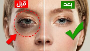 وصفه سحرية للتخلص من الهالات السوداء تحت العين بمكونات سهلة ومتوفرة والنتيجة مبهرة