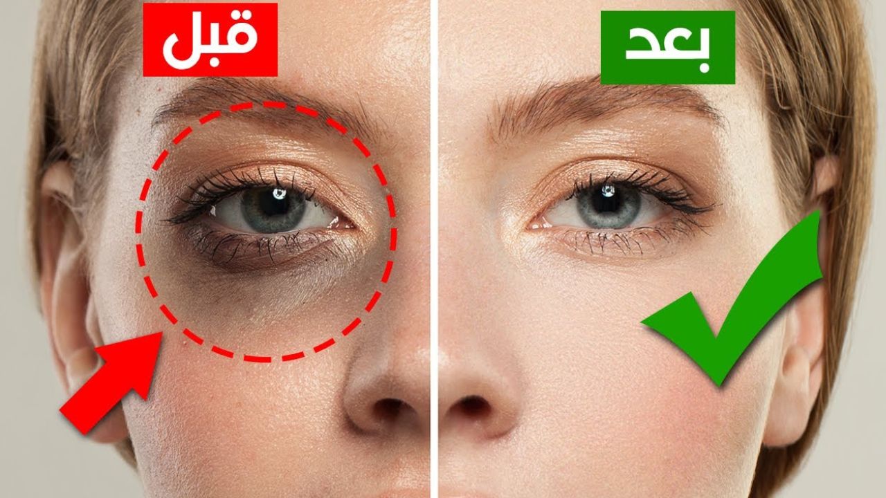 وصفه سحرية للتخلص من الهالات السوداء تحت العين بمكونات سهلة ومتوفرة والنتيجة مبهرة 5 وصفه سحرية للتخلص من الهالات السوداء تحت العين بمكونات سهلة ومتوفرة والنتيجة مبهرة