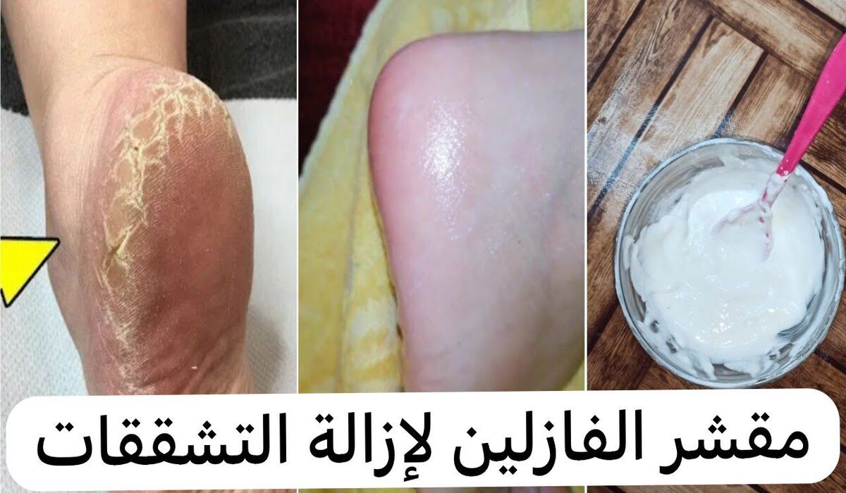 طريقة إزالة الجلد الميت والقشور من القدمين بسهولة “رجعى رجلك ناعمة وتخلصي التشققات والخشونة”
