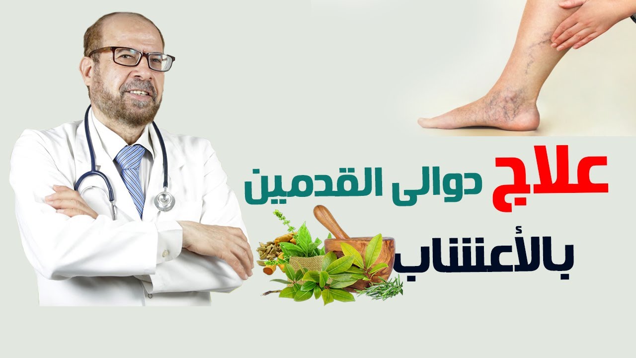 وداعًا لألم الساقيين.. علاج دوالي الساقيين بالأعشاب الطبيعية الفعالة والأسباب وراء الدوالي
