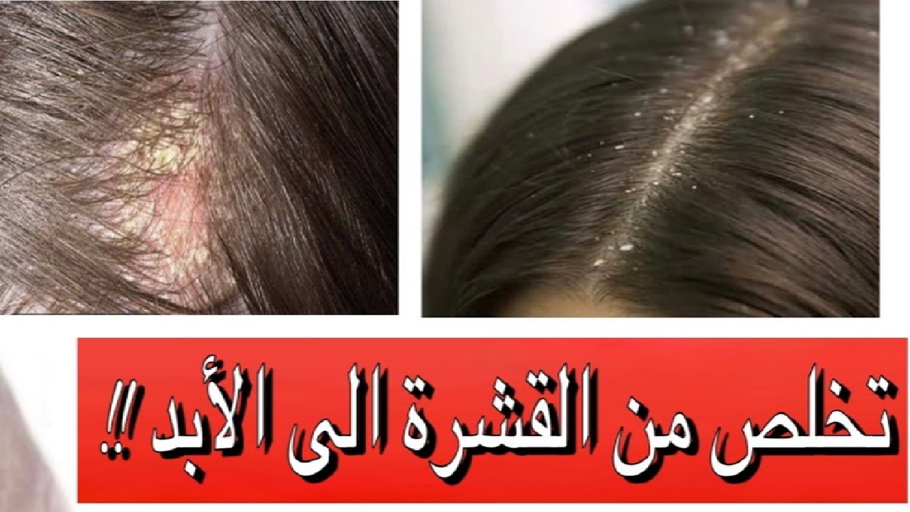 الحل النهائي للتخلص من قشرة الشعر بوصفات طبيعية وفعالة