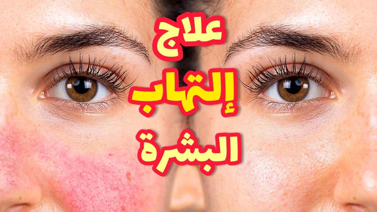 وداعًا لاحمرار وتهيج البشرة بعد إزالة شعر الوجه..إليك أفضل الخلطات الطبيعية الآمنة