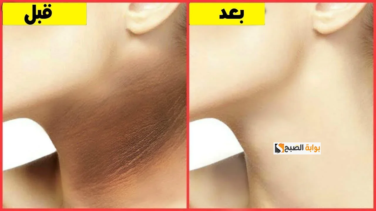 عشان ما تحسيش بالإحراج.. وصفات طبيعية لتفتيح منطقة الرقبة بطرق طبيعية وآمنة وفعالة