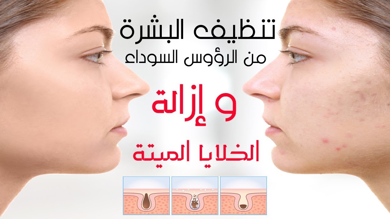 وصفة تقشير البشرة وإزالة الجلد الميت والرؤوس السوداء وتوحيد لون الوجه