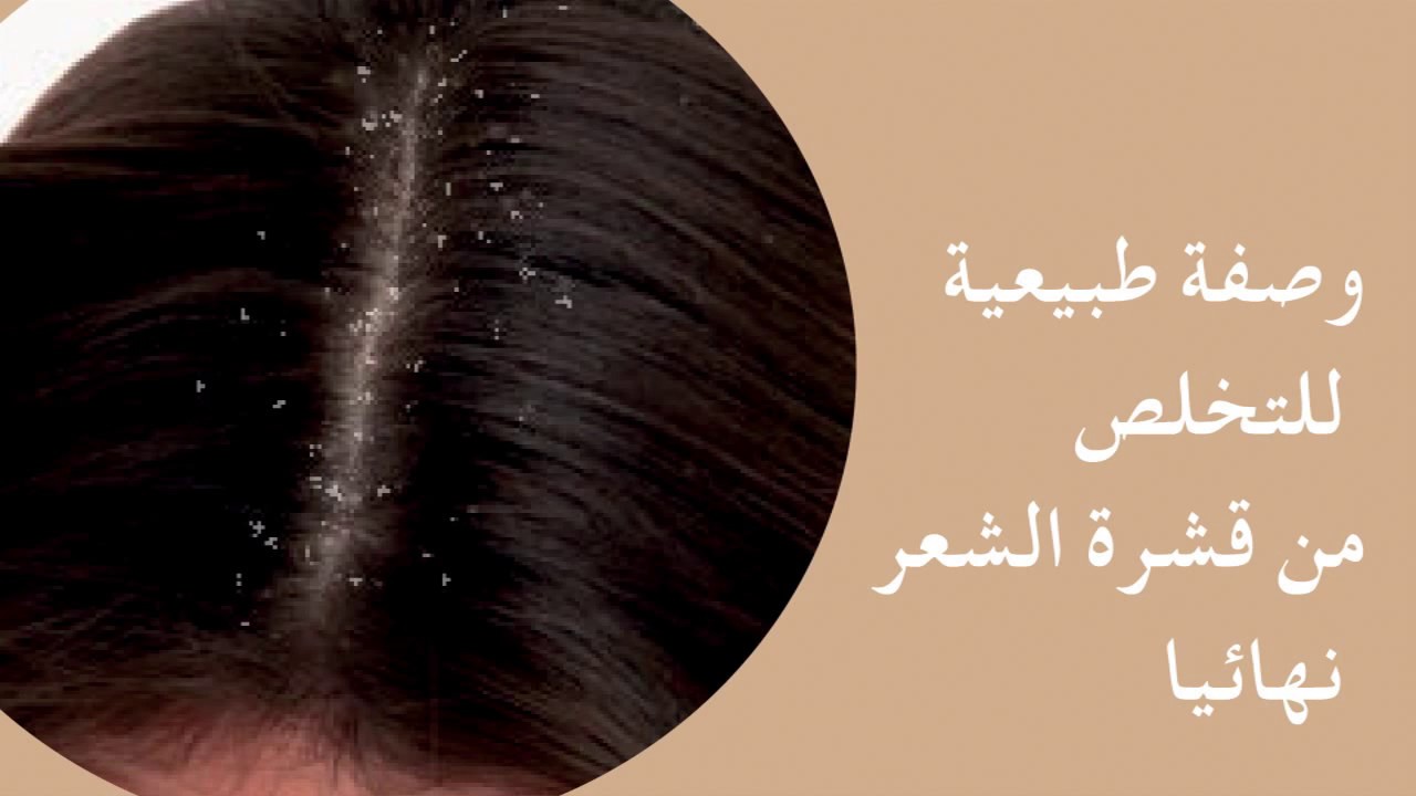 طرق طبيعية وفعالة للتخلص من القشرة بمكونات موجودة في البيت