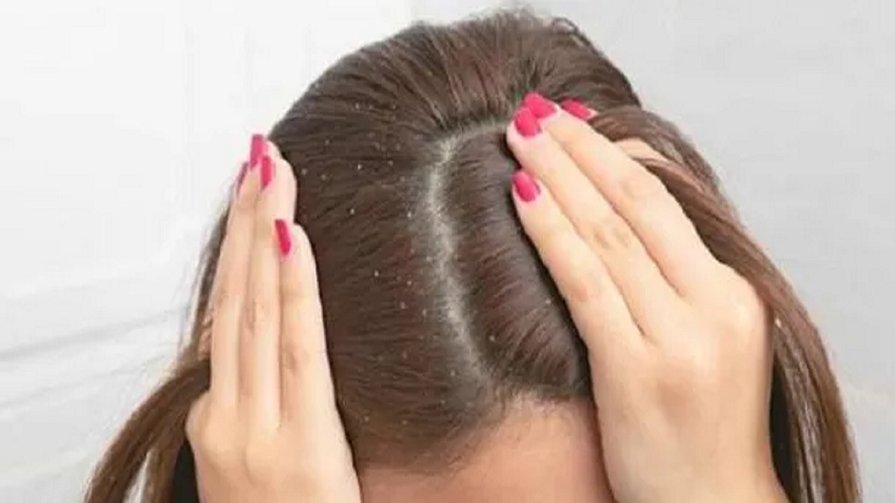 اتبعيها بأمان .. وصفات طبيعية للتخلص من قشرة البشرة بالمنزل بالزيوت والاعشاب الطبية