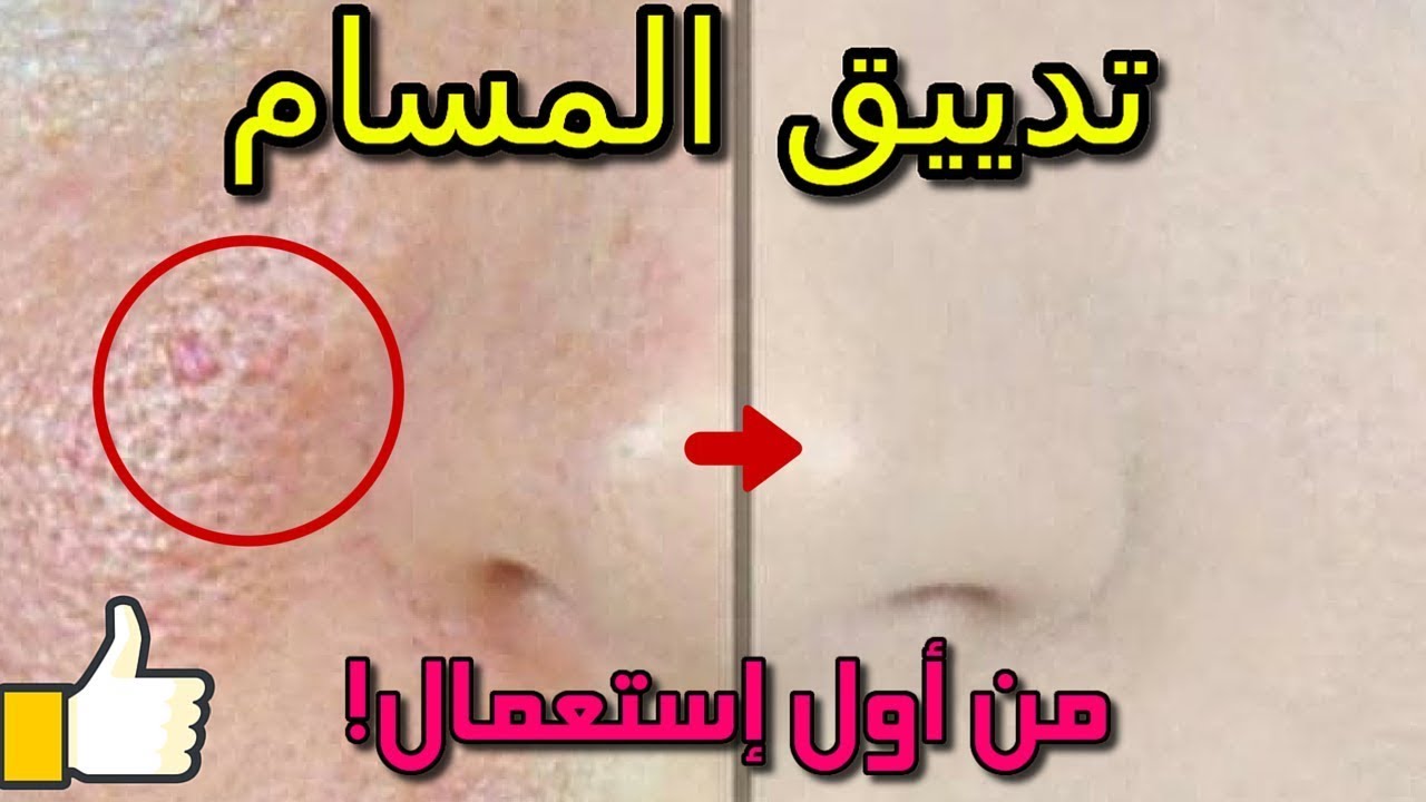 طريقة سد مسام الوجه بخلطات طبيعية موجودة في البيت والنتيجة مبهرة