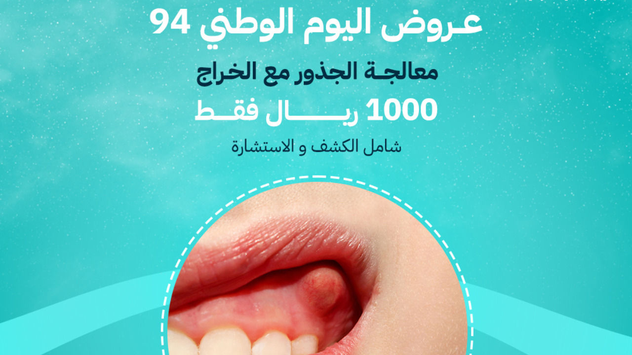 عروض اليوم الوطني اسنان 94 تنظيف وتببيض وإزالة الجير وتركيبات وكشف مجاني لدى بعض مراكز الاسنان