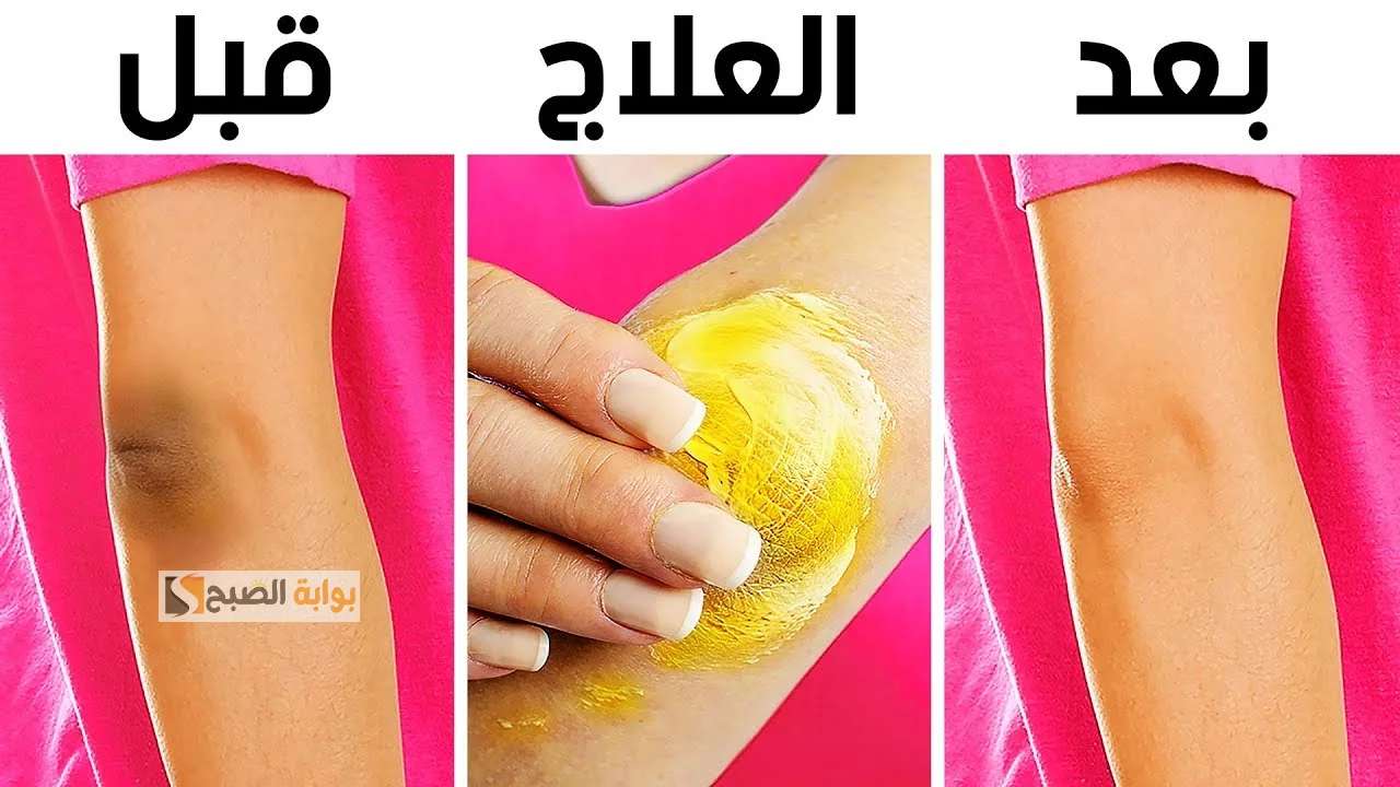 لبشرة أفتح 3 درجات.. وصفات طبيعية لتبييض سواد الركب والأكواع سريعاً خلال يومين من الاستخدام