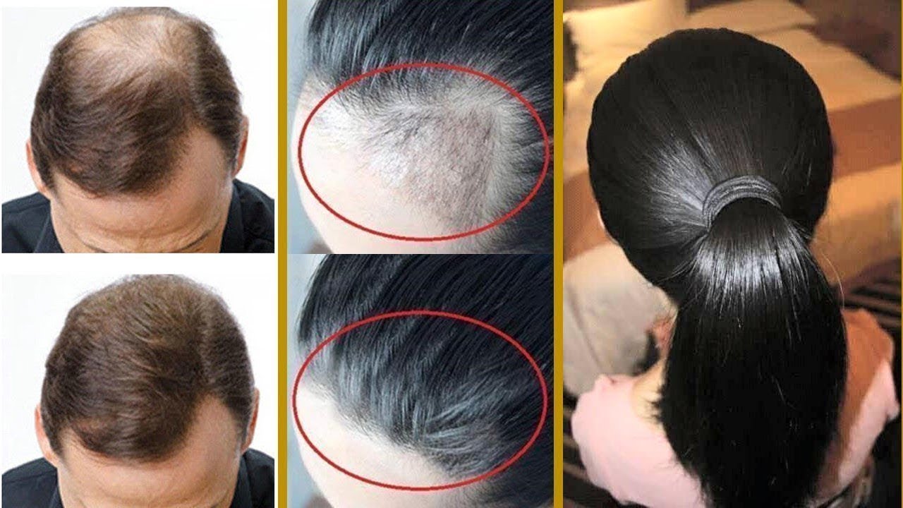 فعالة وسريعة.. وصفة طبيعية لملء فراغات الرأس ومنع التساقط بمكونات اقتصادية