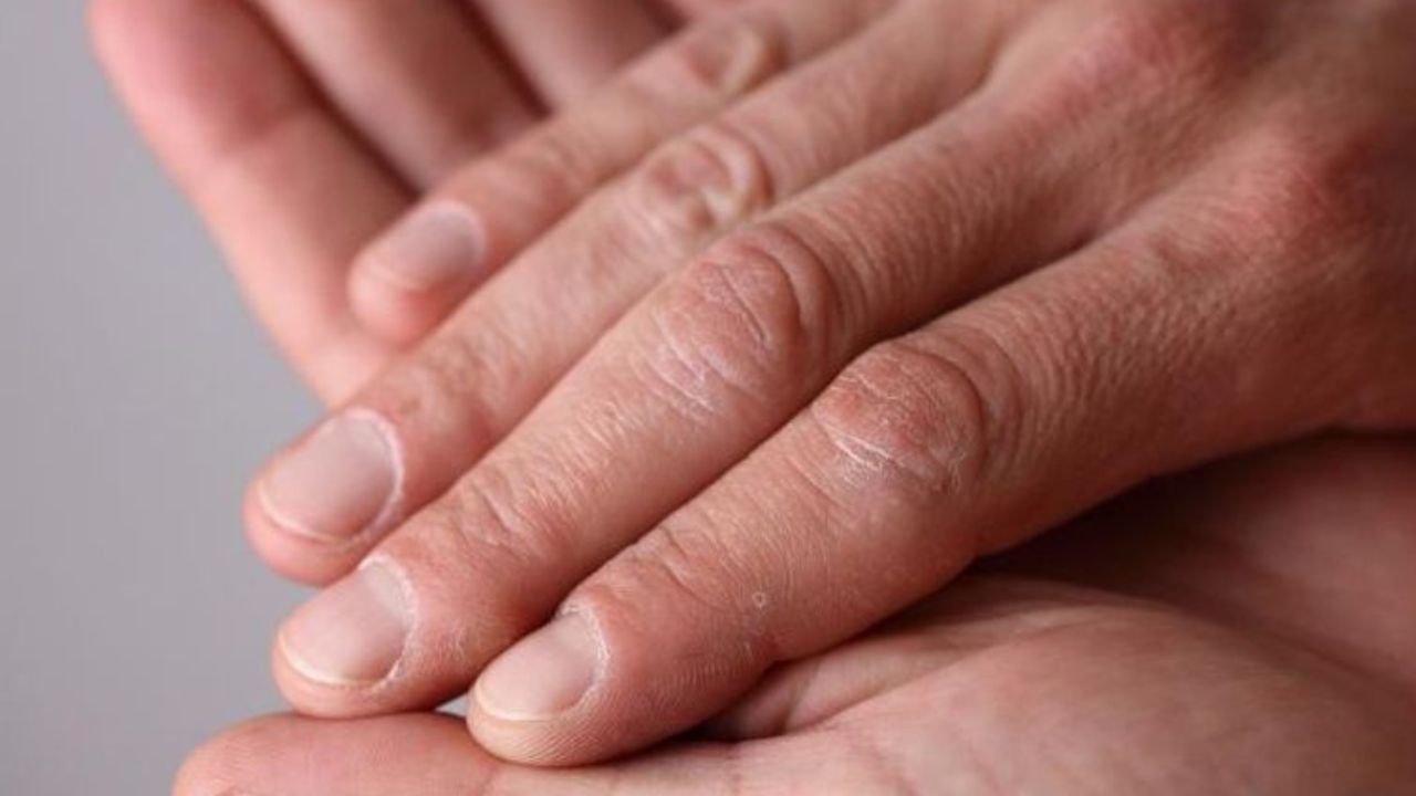 5 وصفات طبيعية لعلاج جفاف اليدين والتشققات هتجيب من الآخر من غير صرف كتير والنتيجة ممتازة