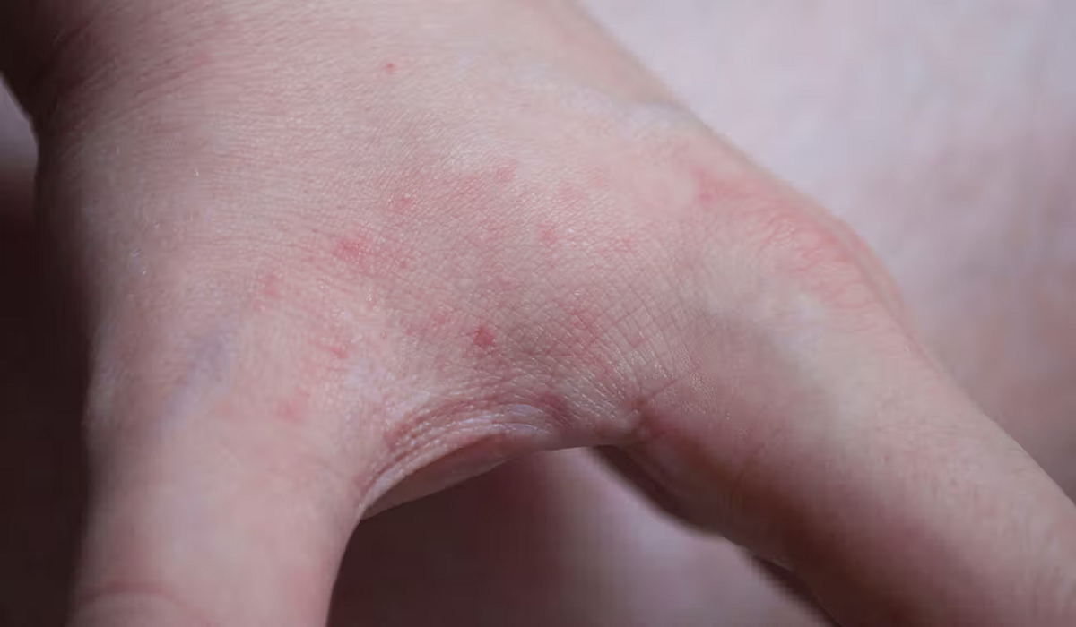 أعراض قرصة البق وأفضل مبيد للقضاء على تلك الحشرة المزعجة