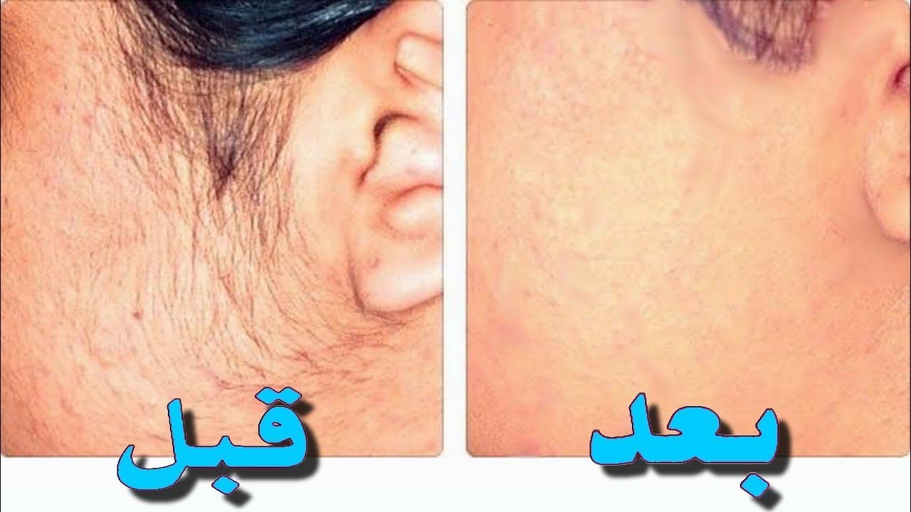 أفضل وصفة لإزالة الشعر الزائد من الوجه والجسم وتفتيح الأماكن الغامقة من أول استعمال