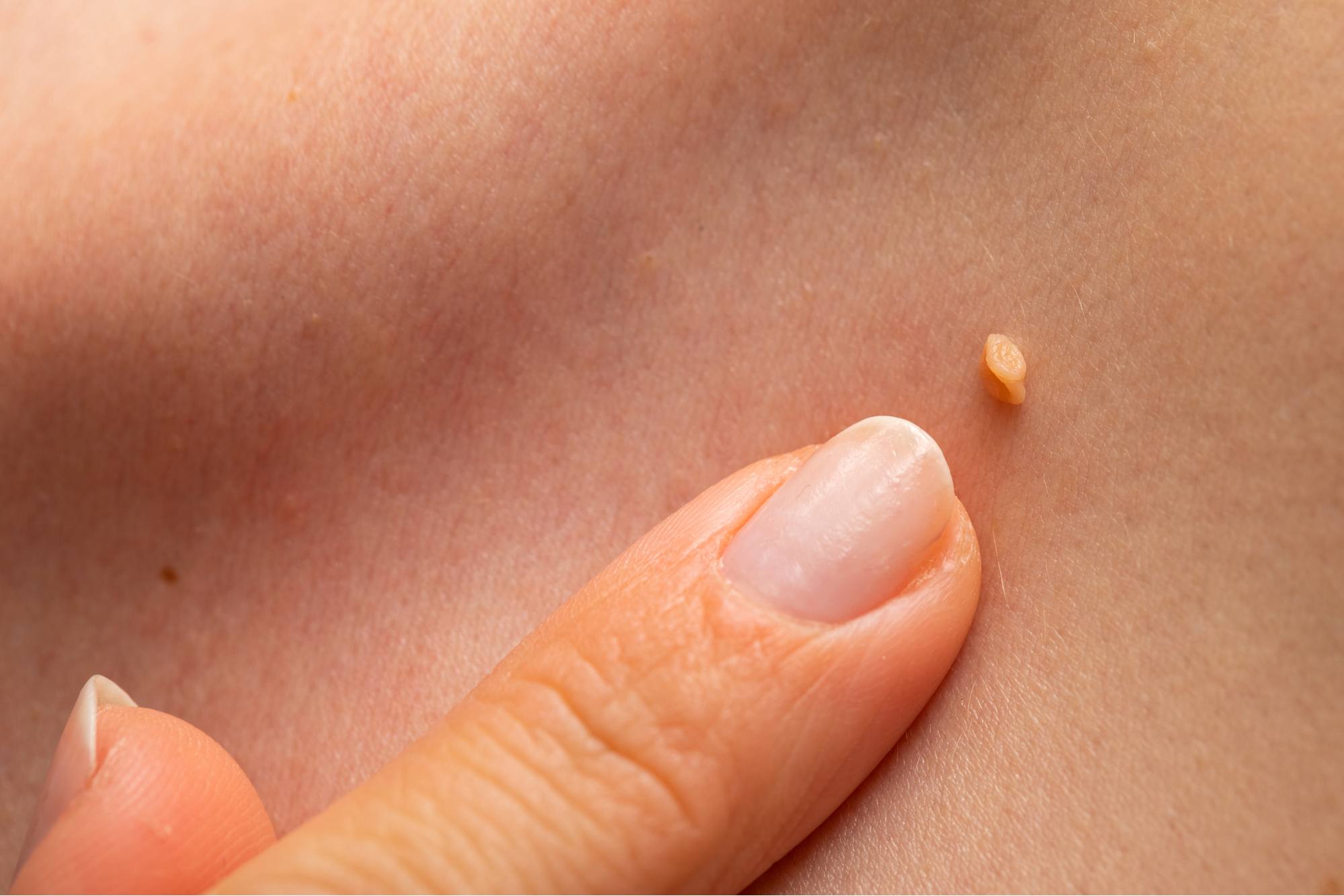 علاجات طبيعية مدهشة تخلصك من الزوائد الجلدية موجودة في المنزل