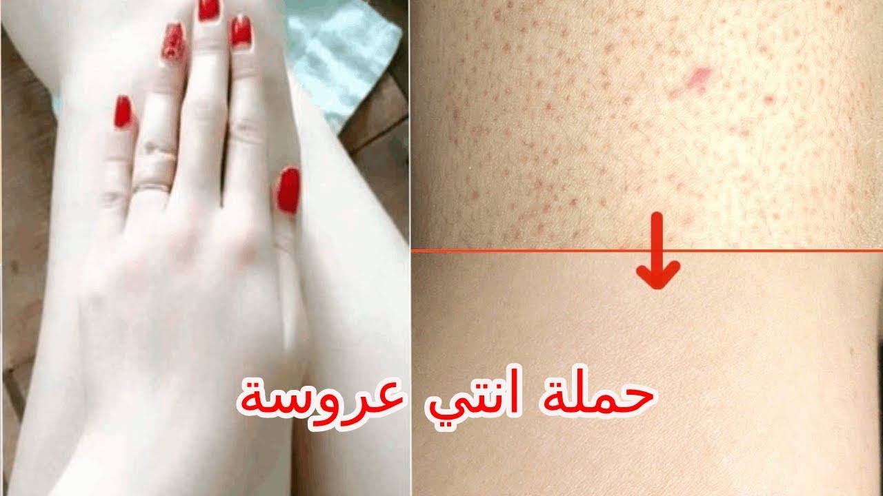 للعرايس.. أقوي خلطات تبييض الجسم والبشرة والتخلص من اسمرار وسواد السنين بطريقة طبيعية