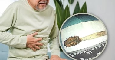 رجل في الصين يبلغ من العمر 64 عامًا يعثر على فرشاة أسنان في أمعائه بعد 52 عامًا من ابتلاعها عندما كان في الثانية عشرة