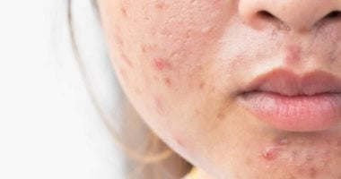 طرق طبيعية فعّالة للتخلص من حب الشباب بخطوات سهلة.. من العسل إلى خل التفاح